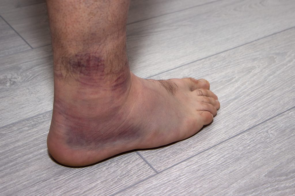 Apa Yang Harus Dilakukan Jika Terkena Cedera Ankle?